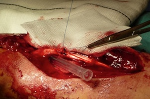 sutura tendon flexor