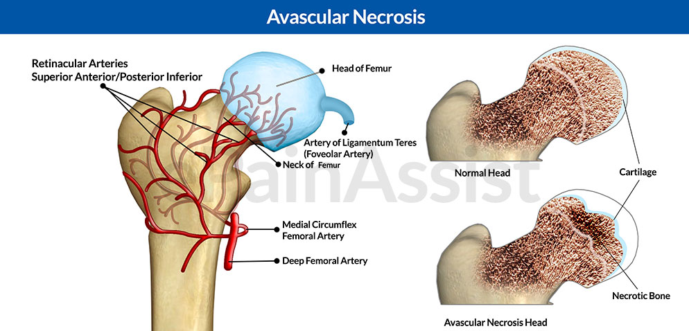 necrosis femur